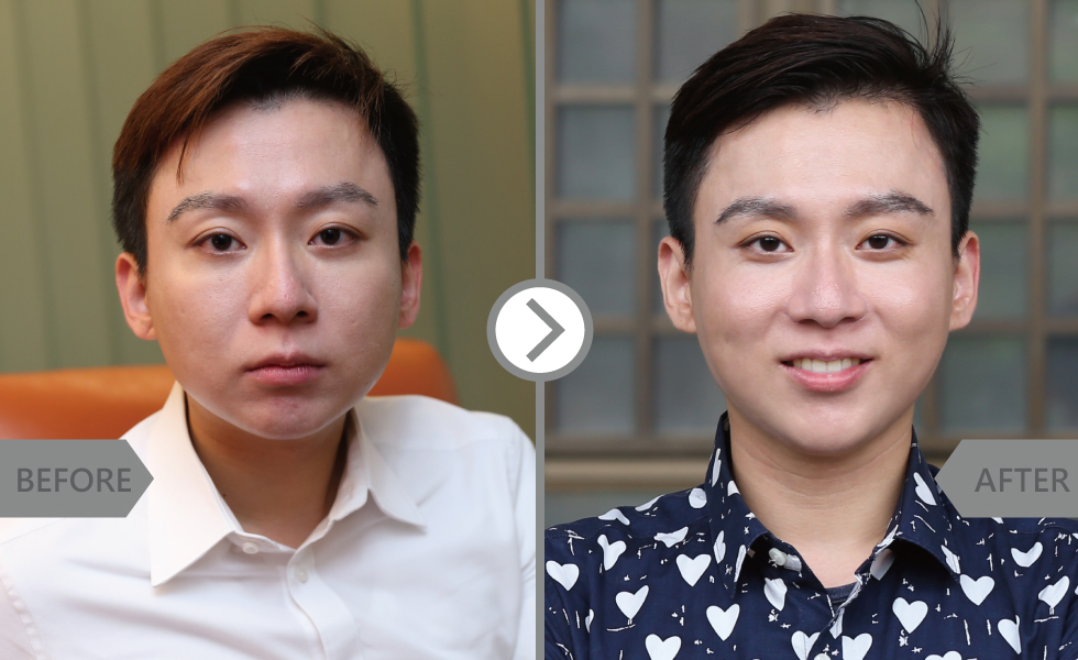 在還沒打玻尿酸前,我的臉型由於嬰兒肥的關係,兩頰看起來太飽滿,下巴短圓,導致有時會被說「臉大」、「沒下巴」。看看上面這張圖,是不是只要一點點玻尿酸,就可以發揮大大的改變呢!讓我臉型拉長,看起來更沉穩。