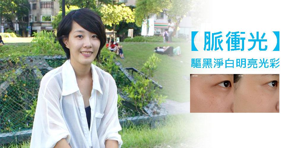 【脈衝光】 輕鬆趕走惱人雀斑