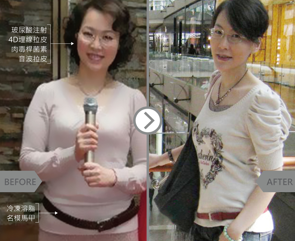 儘管是醫美專業的我,還是逃不過歲月的摧殘。