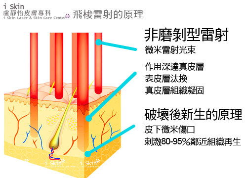 飛梭雷射原理