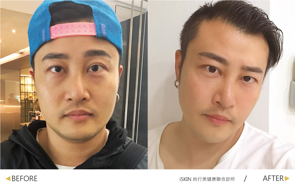 經過林君曄醫師的玻尿酸與除皺瘦臉針治療，我的淚溝獲得修復，魚尾紋也消失了，整個人看起來像年輕了幾歲！