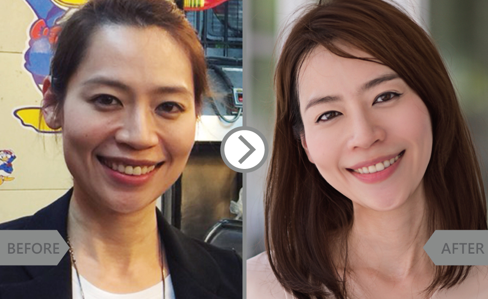 眼周有兩條小溝,笑起來特別顯老也很奇怪