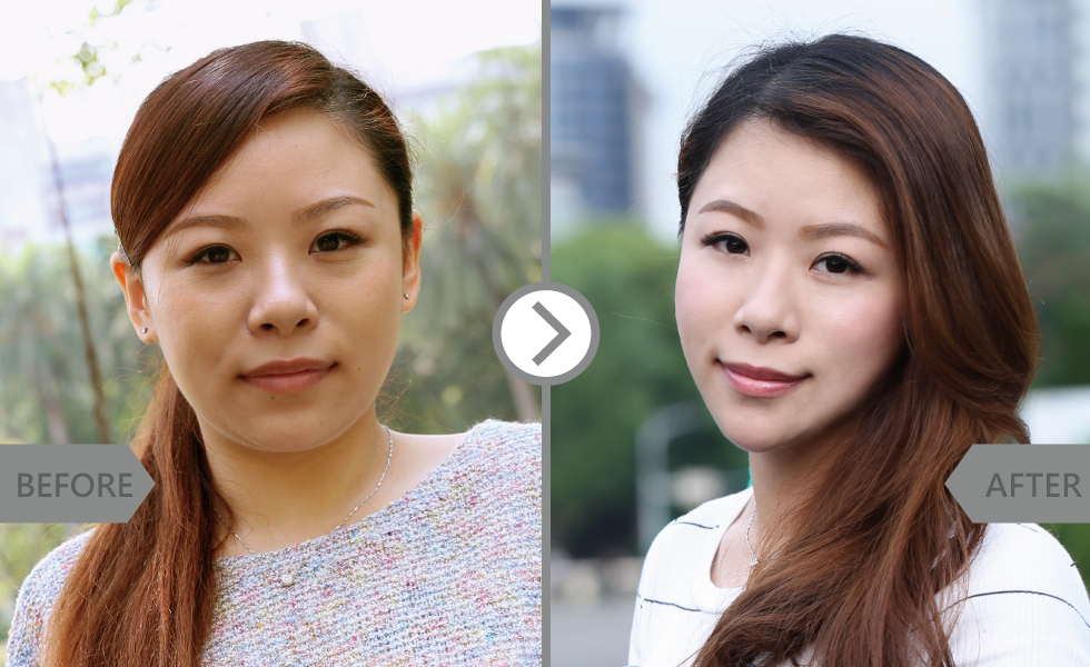 「好上加好」,婚前醫美保養,第三代黃金電波拉皮滿滿的幸福立馬感受!