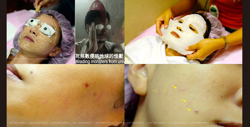 (圖 塗上脈衝光凝膠)(圖 脈衝光治療中)(圖 盧醫師說:臉頰上就是微血管擴張的效果)