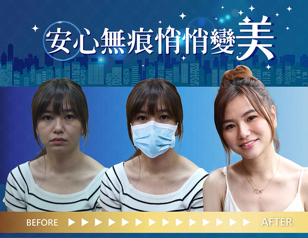 iSKIN防護升級，讓您安心啟動無痕變美程序
