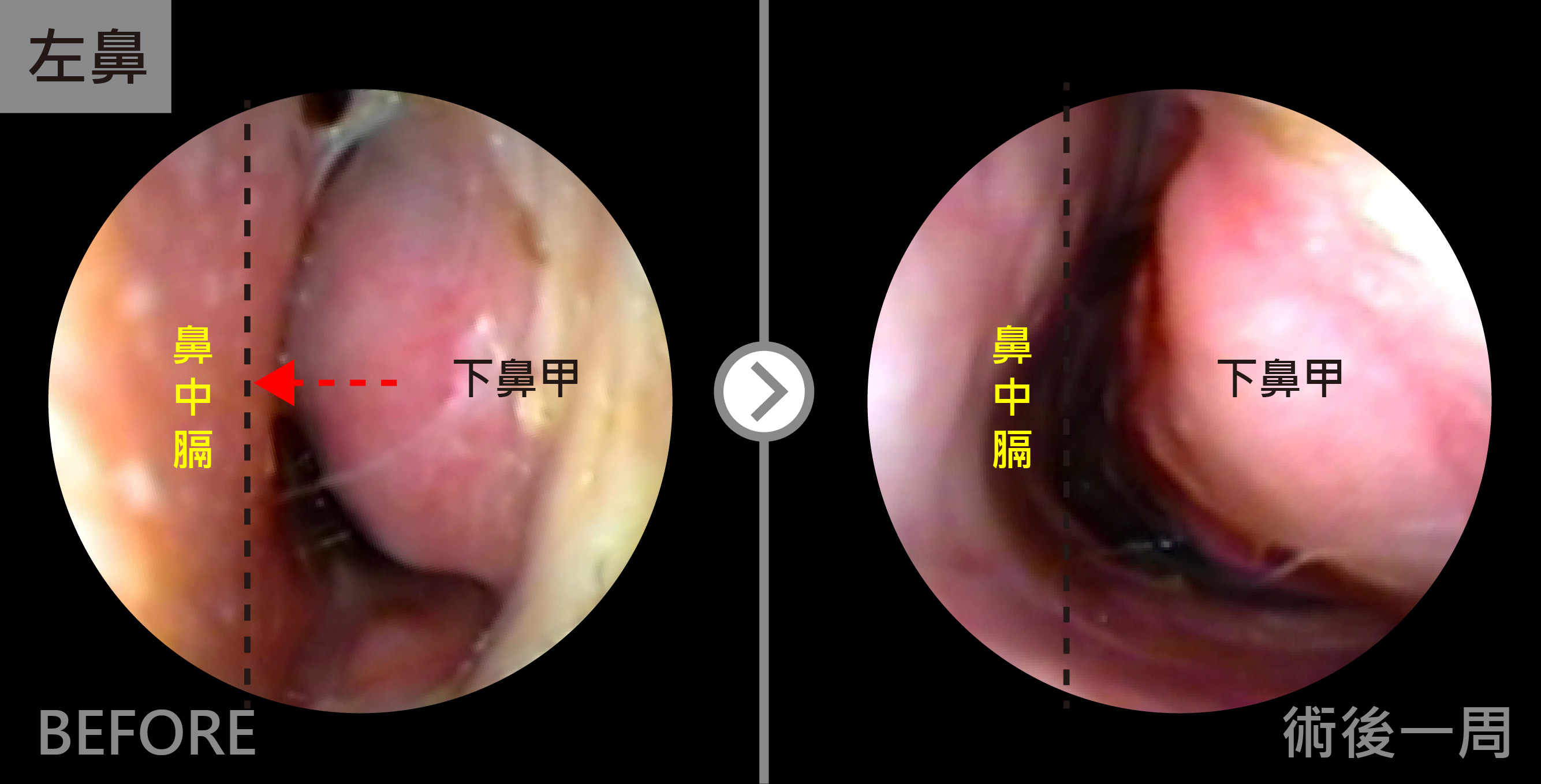 廣達雷射術後一周,傷口還有點結痂,但已經能明顯感受到呼吸比較順暢。