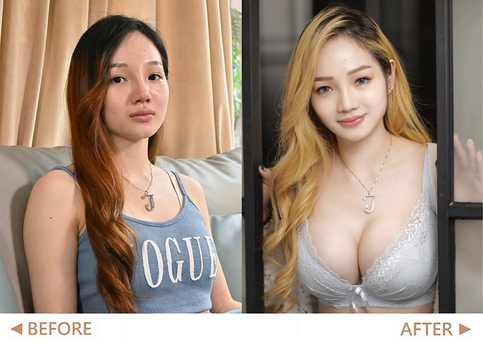 前後差異圖 – 魔滴術前術後的改變,讓我找回自信和美麗的新人生。