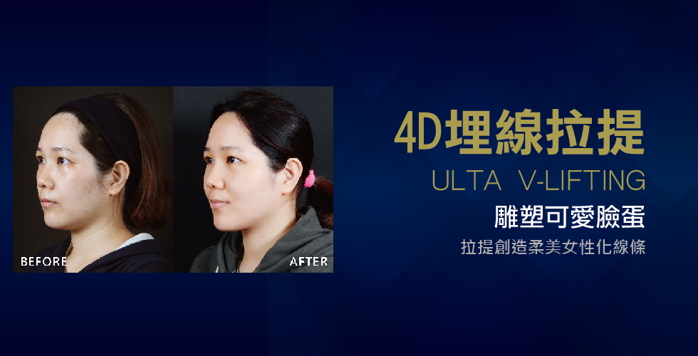 【4D埋線拉提】雕塑可愛臉蛋
