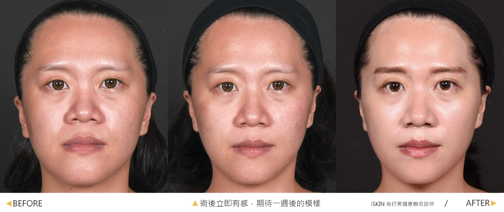 陳醫師用了2cc的玻尿酸替我做到了蘋果肌的填補、中頰的拉提,改善了我單邊的法令紋問題,使我的兩臉更對稱協調。