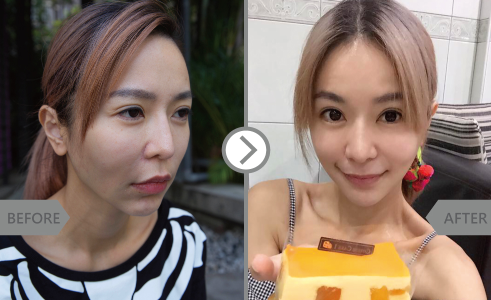 現在臉頰變得圓潤自然,法令紋也修飾掉了,從疲累無神的我,又回復到24歲女般的神采奕奕!