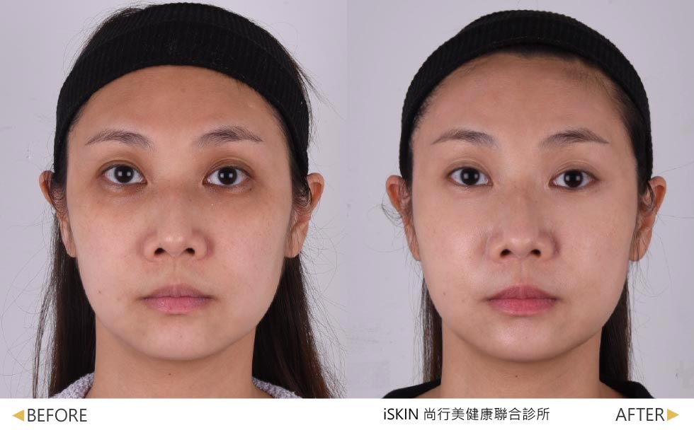 玻尿酸填補臉頰凹陷同時一起將蘋果肌補足及中頰拉提,改善淚溝,視覺疲累感消失,不再虛累累。