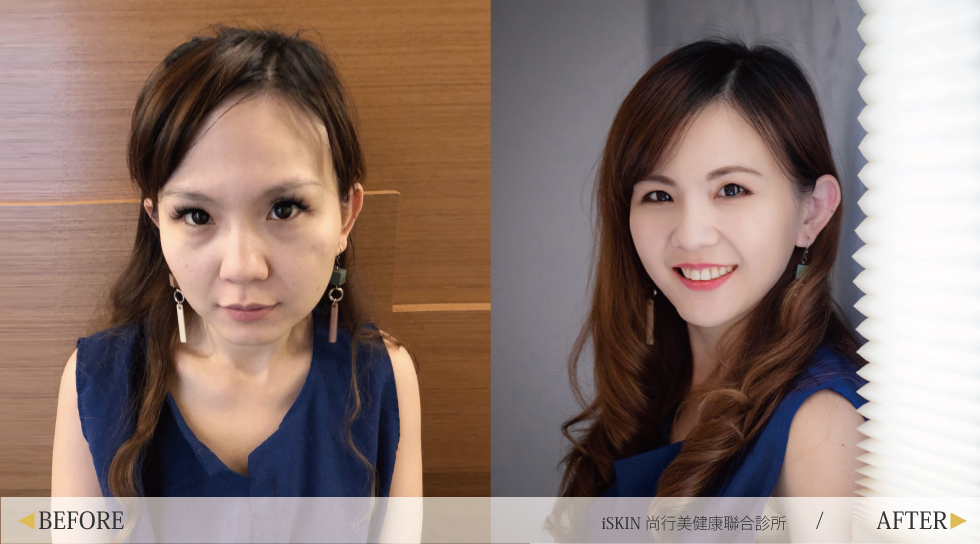 治療後的我眼周淚溝明顯飽滿起來,連黑眼圈也不見了,臉頰上的凹疤也改善很多,側面看下巴比例也很自然,真的很謝謝盧醫師。