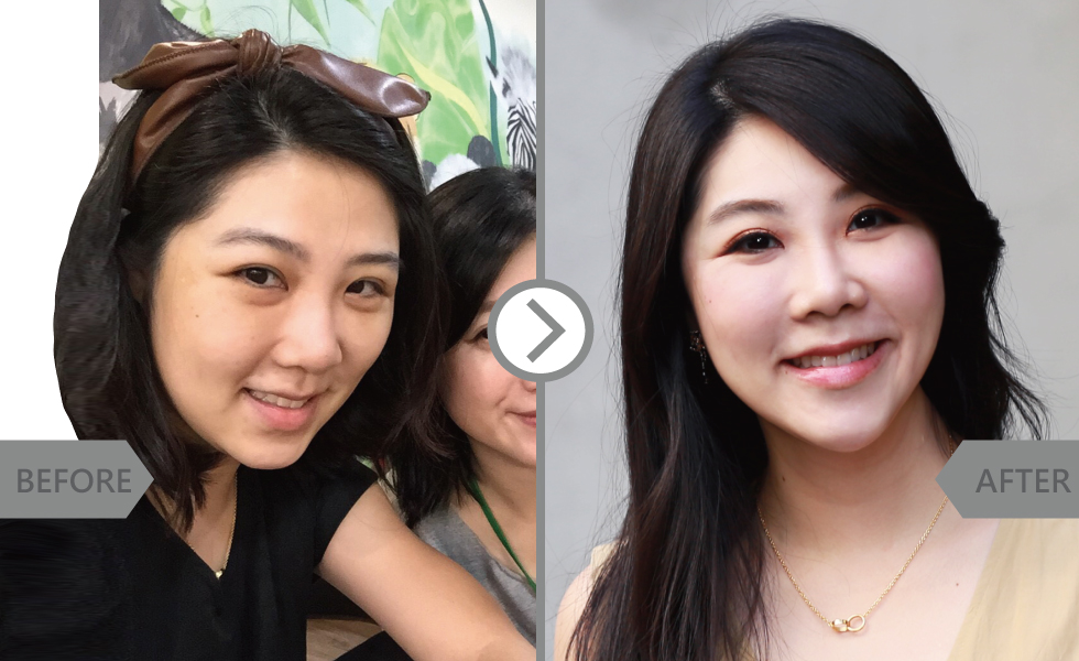 我不僅要活得漂亮,我也重視身上小細節的美,希望改善我臉上的凹陷與鬆弛感,讓自己有朝氣一點。