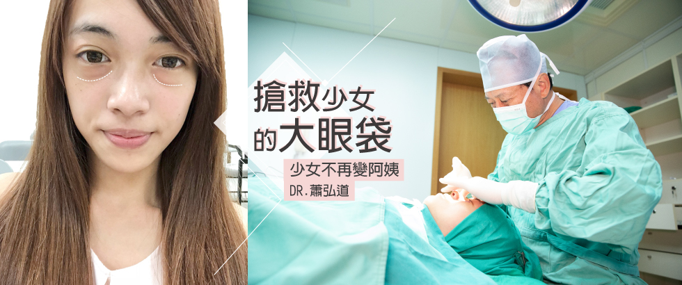 【眼袋手術評價與見證】搶救少女的大眼袋，小姐不再變阿姨-小亞