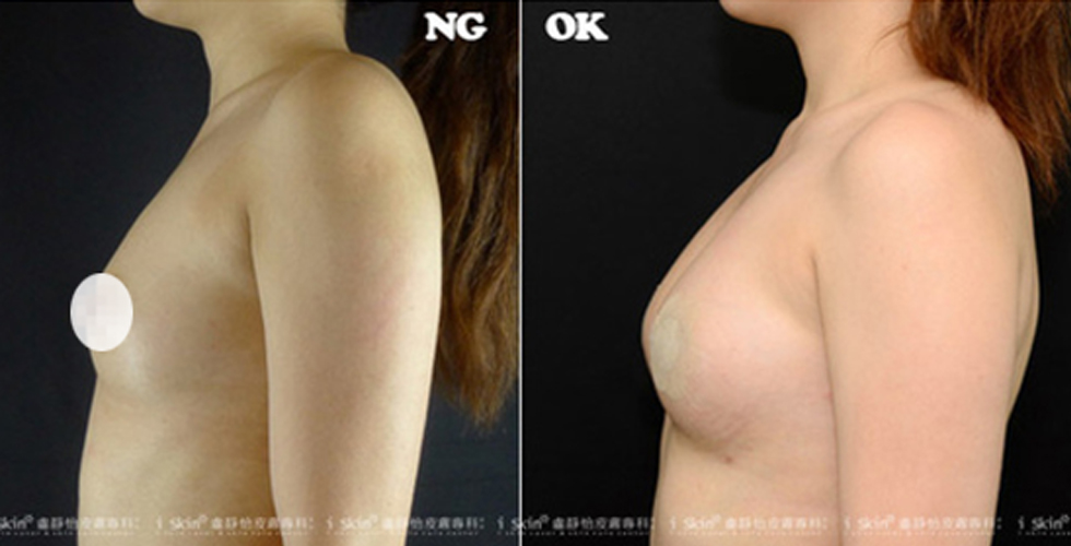 經過自體脂肪隆乳後,呈現性感渾圓的胸型