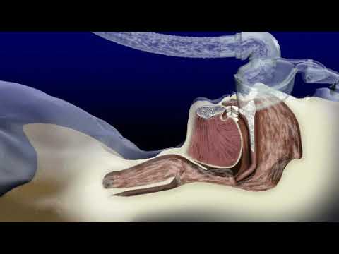陽壓呼吸器 CPAP