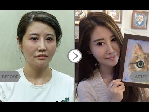 iSkin 盧靜怡皮膚專科診所【玻尿酸】行銷公關顏值提升 舞台更寬廣_Susan