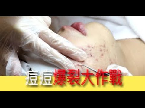 超療癒臉頰粉刺清除實況~~痘痘爆裂~~