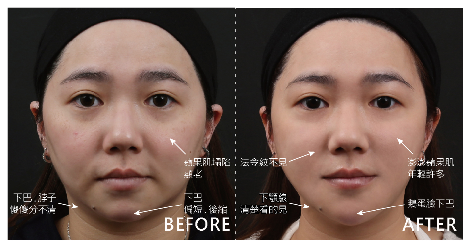 人老了、膠原蛋白流失就容易鬆弛，看看我的脖子跟下巴都要連成一線了。透過除皺瘦臉針治療後，輪廓線變清楚了；玻尿酸填補在下巴，讓臉型拉長，從圓臉變成鵝蛋臉，另外，再利用玻尿酸進行中頰拉提，蘋果肌重新長出來了、法令紋就此說Bye；4D皮秒雷射幫我改善斑點、色素的問題。