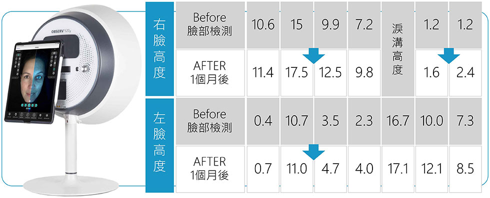 專業級肌膚檢測儀數據,Before和After比較;如上數字為臉部高度的檢測,數字高代表此部位臉頰較支撐和澎潤,數字低代表此部位臉頰較凹陷。