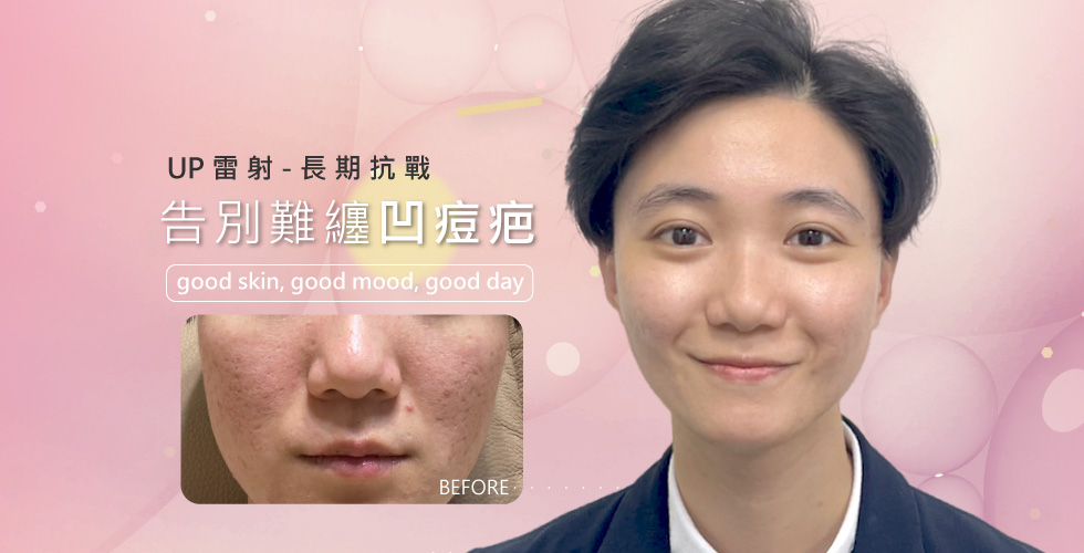 【雷射光療】UP雷射長期抗戰，告別難纏凹痘疤 –Ivory