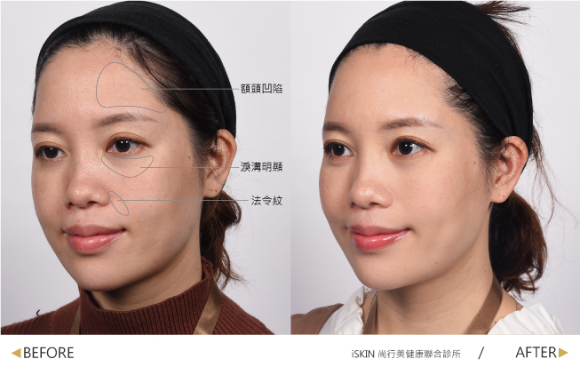 盧靜怡醫師針對小梅的額頭、眼下淚溝處與鼻翼兩側法令紋,施打玻尿酸,做局部微調。