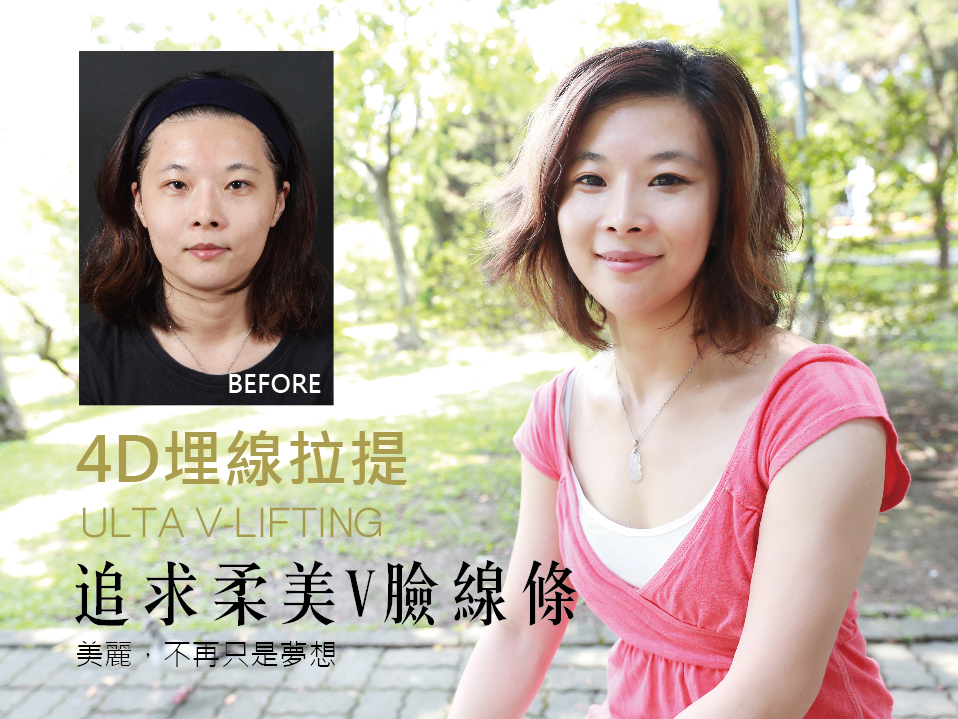 【4D埋線拉皮】追求柔美V臉線條