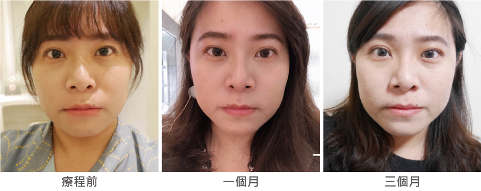 這是正臉施打音波後的變化(不笑)可以看到下巴的輪廓變明顯了