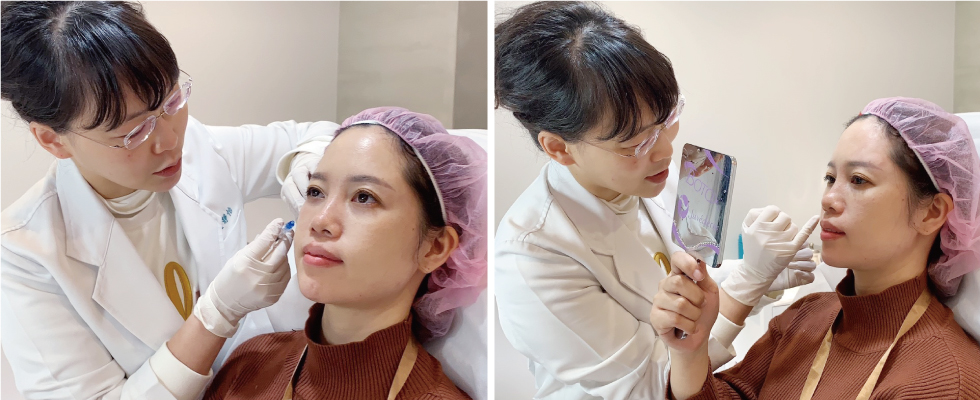 盧靜怡醫師先用鈍針為我需要改善的地方填補玻尿酸,再用細針作微調,真的超級細心的!