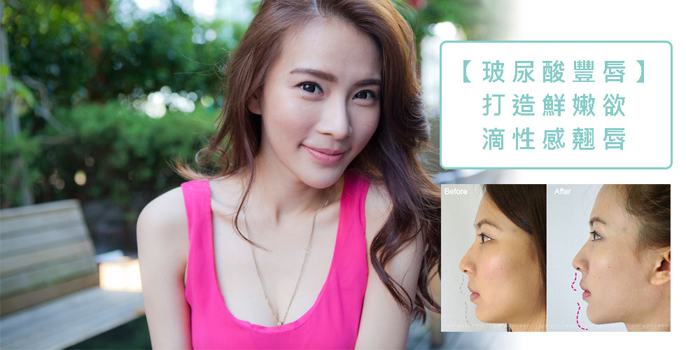 【玻尿酸豐唇】新一代美女賴珮鈺打造鮮嫩欲滴性感翹唇