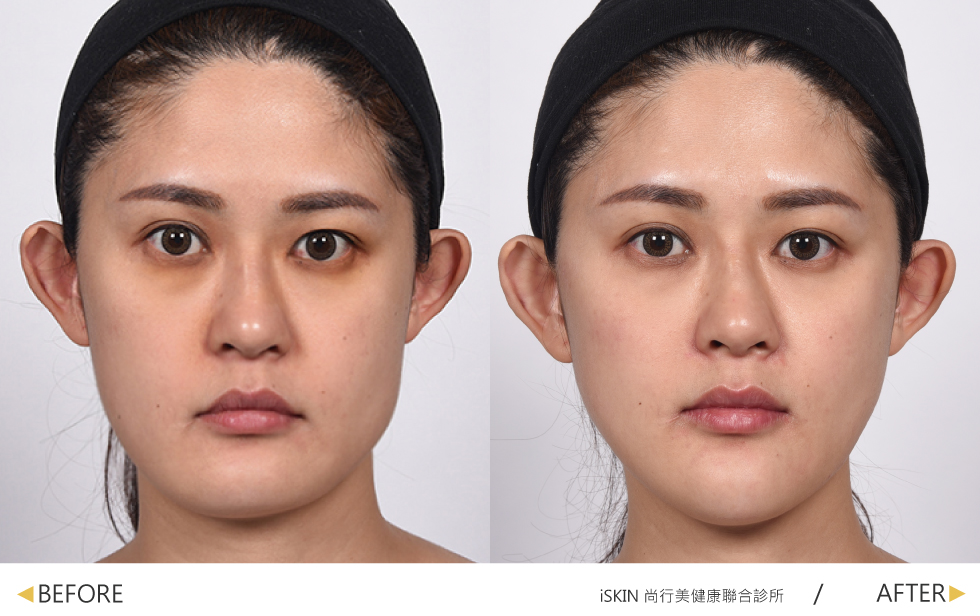 玻尿酸與除皺瘦臉針療程結束後,子瑩的臉退去疲憊,不只顯得精神許多,五官也更加立體。