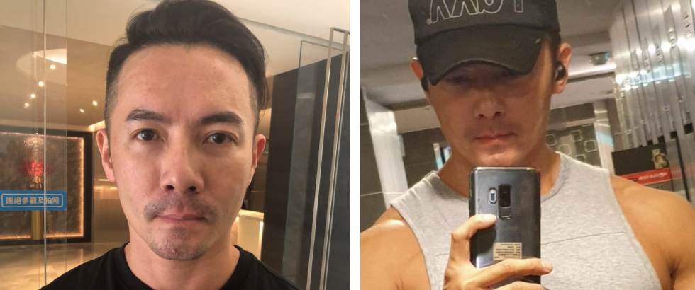 日夜顛倒的生活,即使我有固定健身,歲月的痕跡也提早在我的臉部報到。我開始慎重考慮接受玻尿酸與除皺瘦臉針治療。