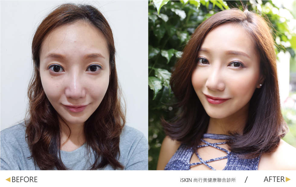 林君曄醫師為我用玻尿酸改善法令紋與拉提中頰,改善我看起來沒精神的煩惱。