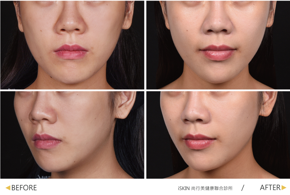 大家可以明顯看到我的雙頰比以前柔順,感覺也沒打了很多東西,但真的柔順很多,看起來更趨近於飽滿的鵝蛋臉,側面看也是,蘋果肌沒有補的很誇張,反而是很自然的那種弧度,皺眉時我的皺眉紋也不會一直跑出來了。