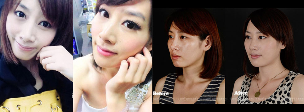 術前術後Before & After淚溝凹槽明顯改善,看起來飽滿膨彈(照片由S小姐本人所提供)。▲術前淚溝較深,下巴形狀則略呈方型。右圖為已注射玻尿酸,經由專業並兼顧美感的皮膚科醫師,塑出線條精巧的臉型與下巴線條,成功打造Double S曲線。