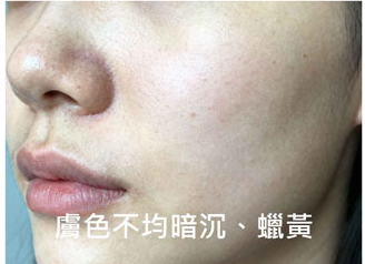 膚色不均、蠟黃