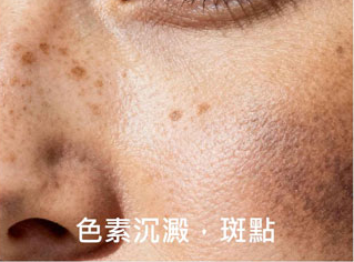 色素沉澱、斑點