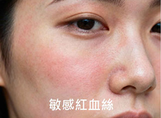 敏感紅血絲