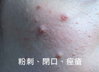粉刺、痘痘