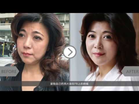 iSkin 盧靜怡皮膚專科診所【電波拉皮】美魔女告別嘴邊肉_醫美諮詢師Lily