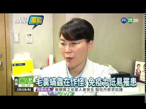 iSKIN盧靜怡醫師受邀《華視新聞》評價毛囊有蟎蟲！一臉爛瘡誤為痘